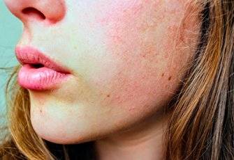 Apprendre à soulager les symptômes de la dermatite