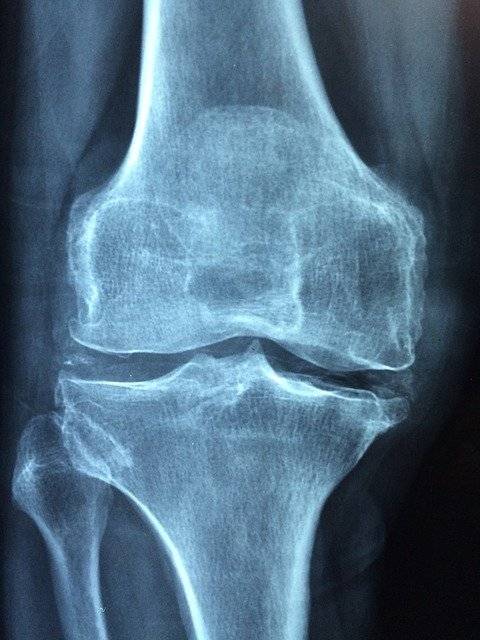 Arthrose de la cheville : Une maladie silencieuse pour beaucoup