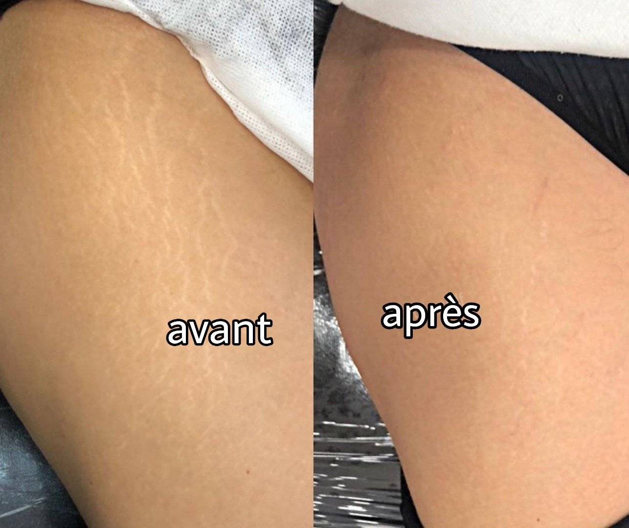 Remèdes maison qui réduisent les vergetures rouges et blanches