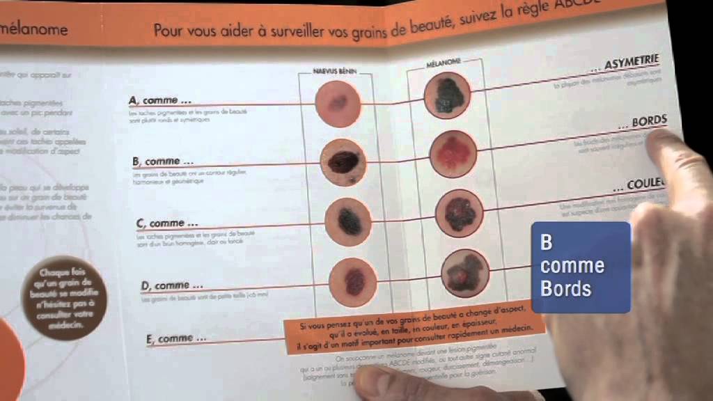 Cancer de la peau : si vous appartenez à ce groupe, il y a de fortes chances de développer un basaliome