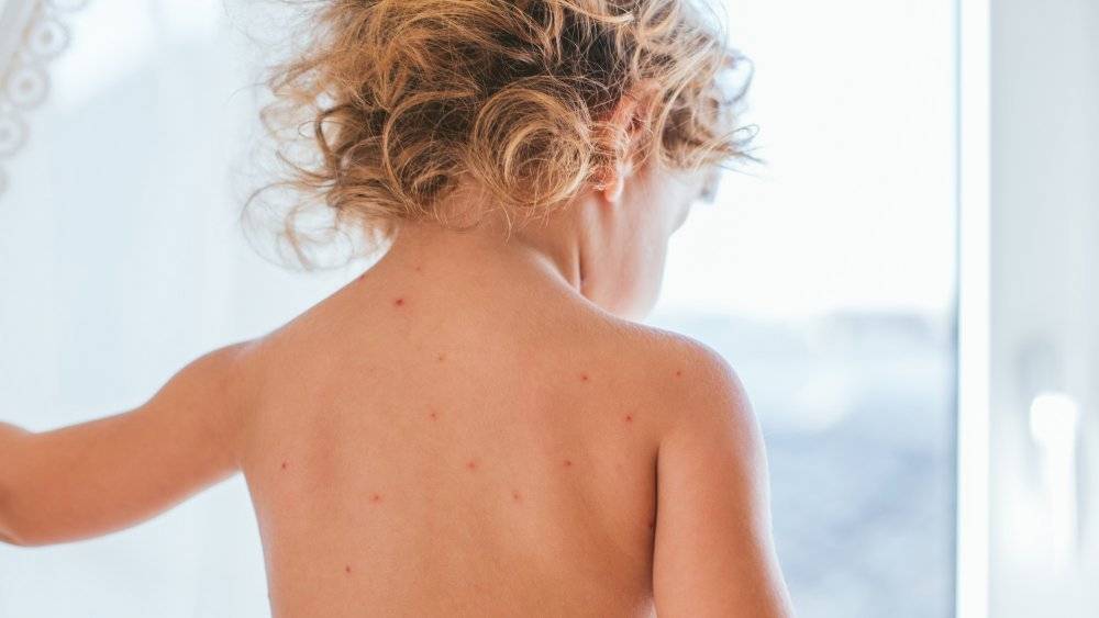 maladie de la peau d’été : c’est à quoi ressemble l’éruption chaude